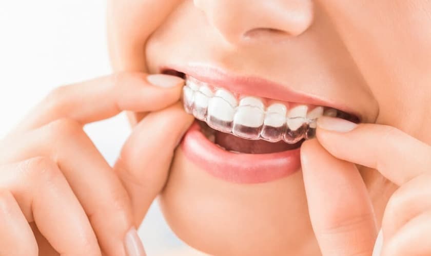 Invisalign in Manhattan - Park Avenue Orthodontics: Dr. Janet Stoess-Allen
