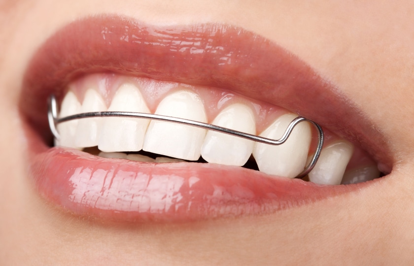 Benefits of Using a Dental Retainer